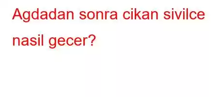 Agdadan sonra cikan sivilce nasil gecer?